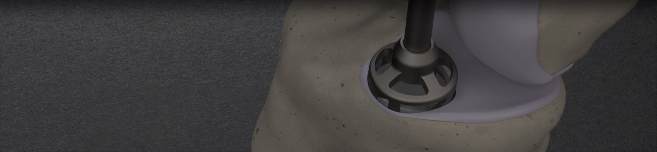 About the Overture Orthopaedic Mission